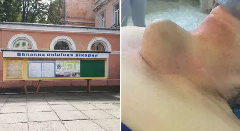 Фото пухлини щитоподібної залози