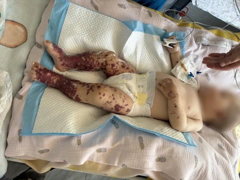 У Чернівцях медики врятували 10-місячного хлопчика від смертельної інфекції
