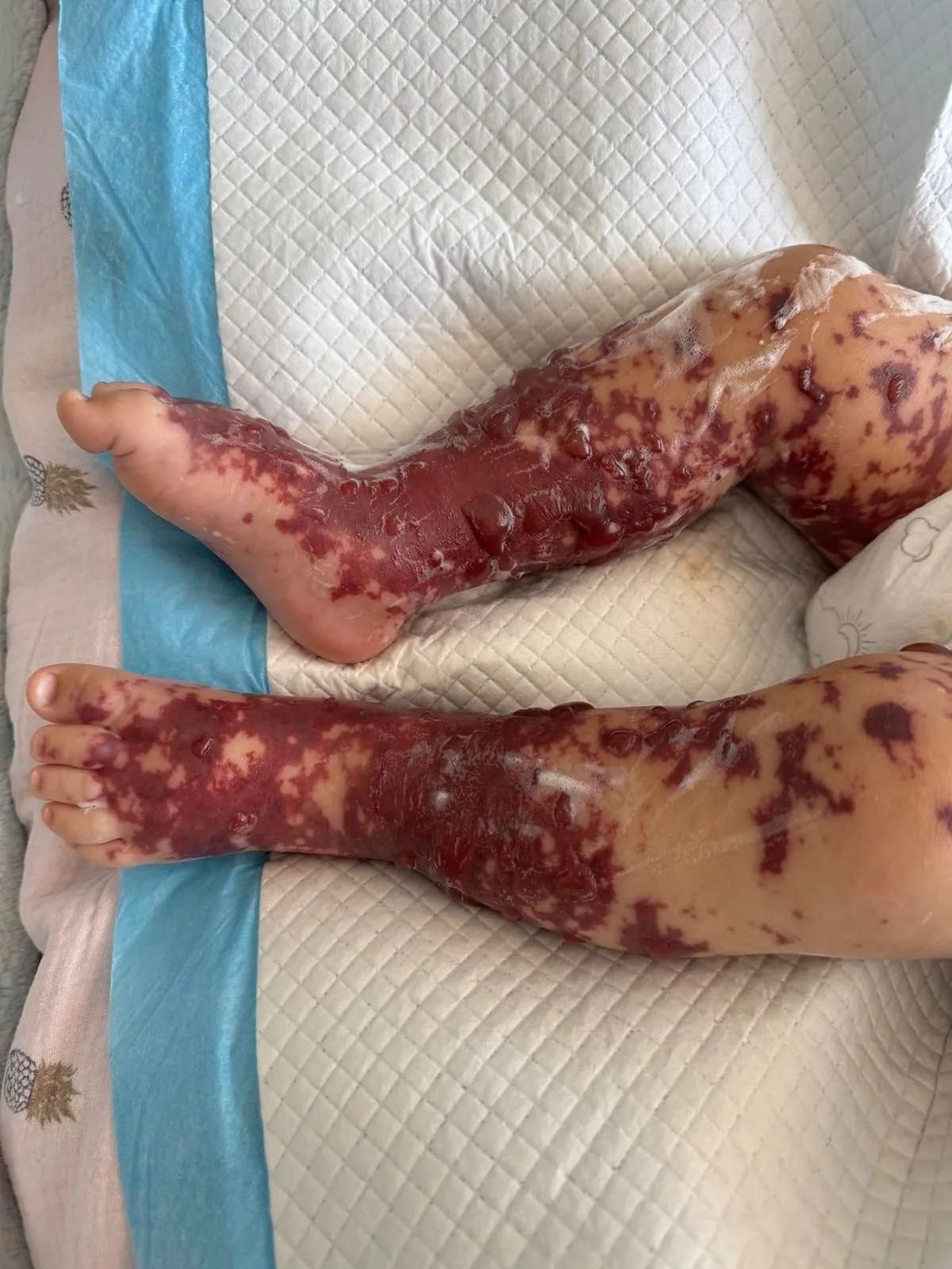 У Чернівцях медики врятували 10-місячного хлопчика від смертельної інфекції
