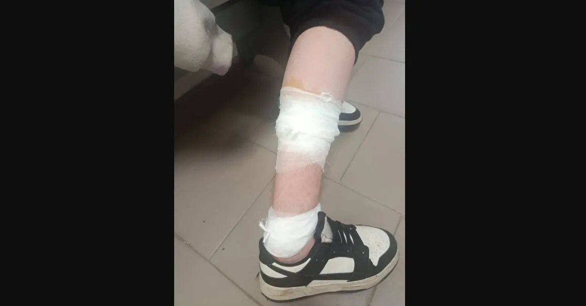 Собаки покусали дитину в Садгорі: батьки б'ють на сполох